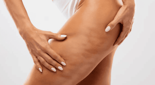 Comment dire adieu à la cellulite de façon durable ?