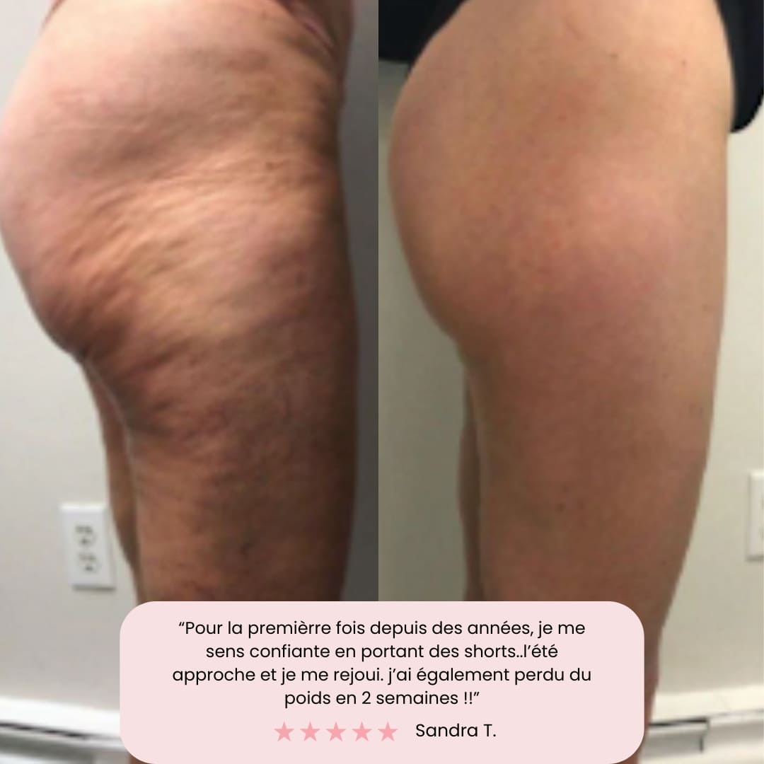 Masseur Anti-Cellulite ResKin™